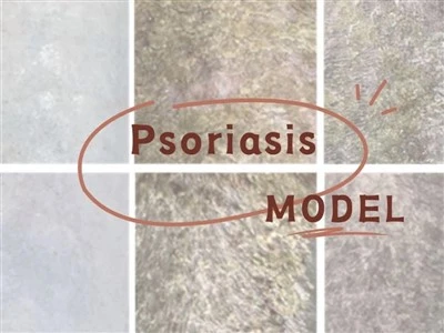 Psoriaasi mudel